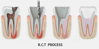 Save Your Tooth – Advanced Root Canal Treatment in Noida